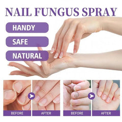 Nail Fungus Curing Spray